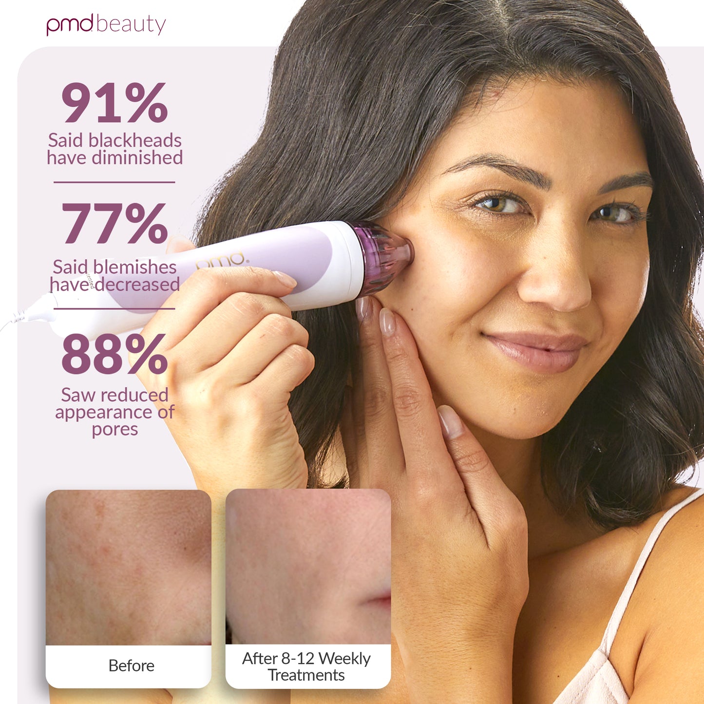 Personal Microderm Classic