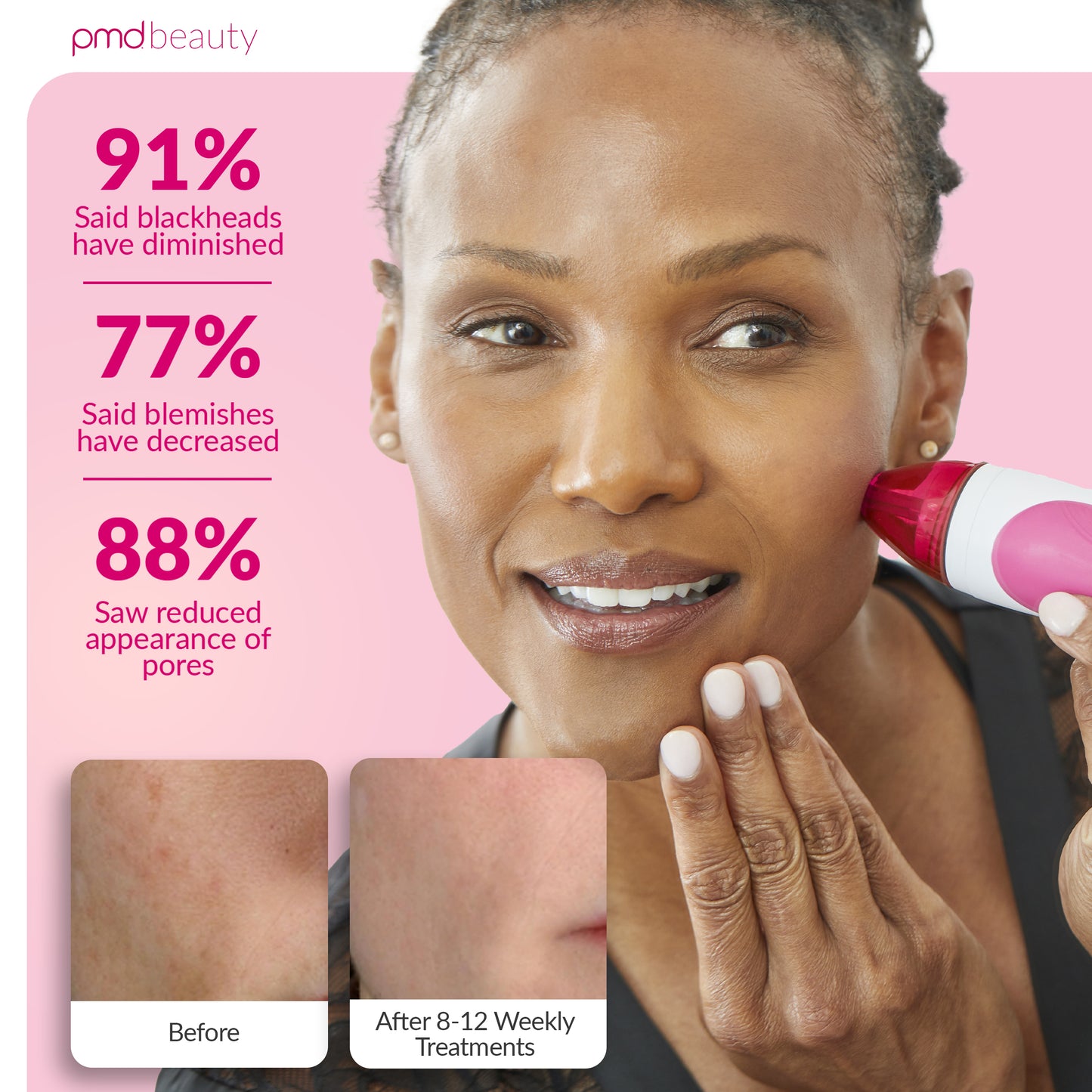 Personal Microderm Pro