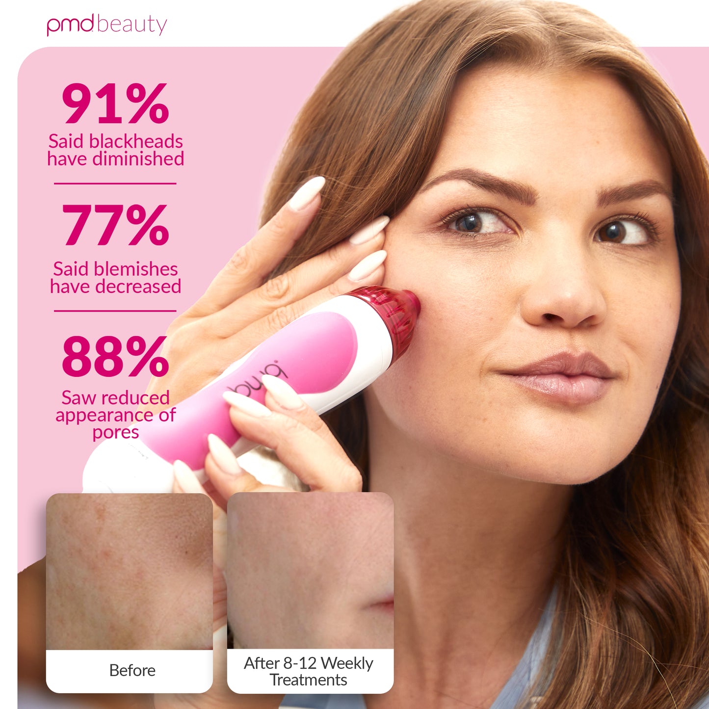 Personal Microderm Classic