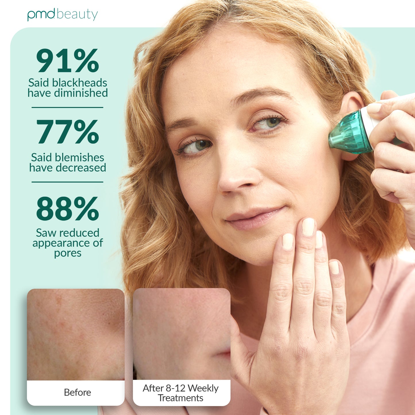 Personal Microderm Classic