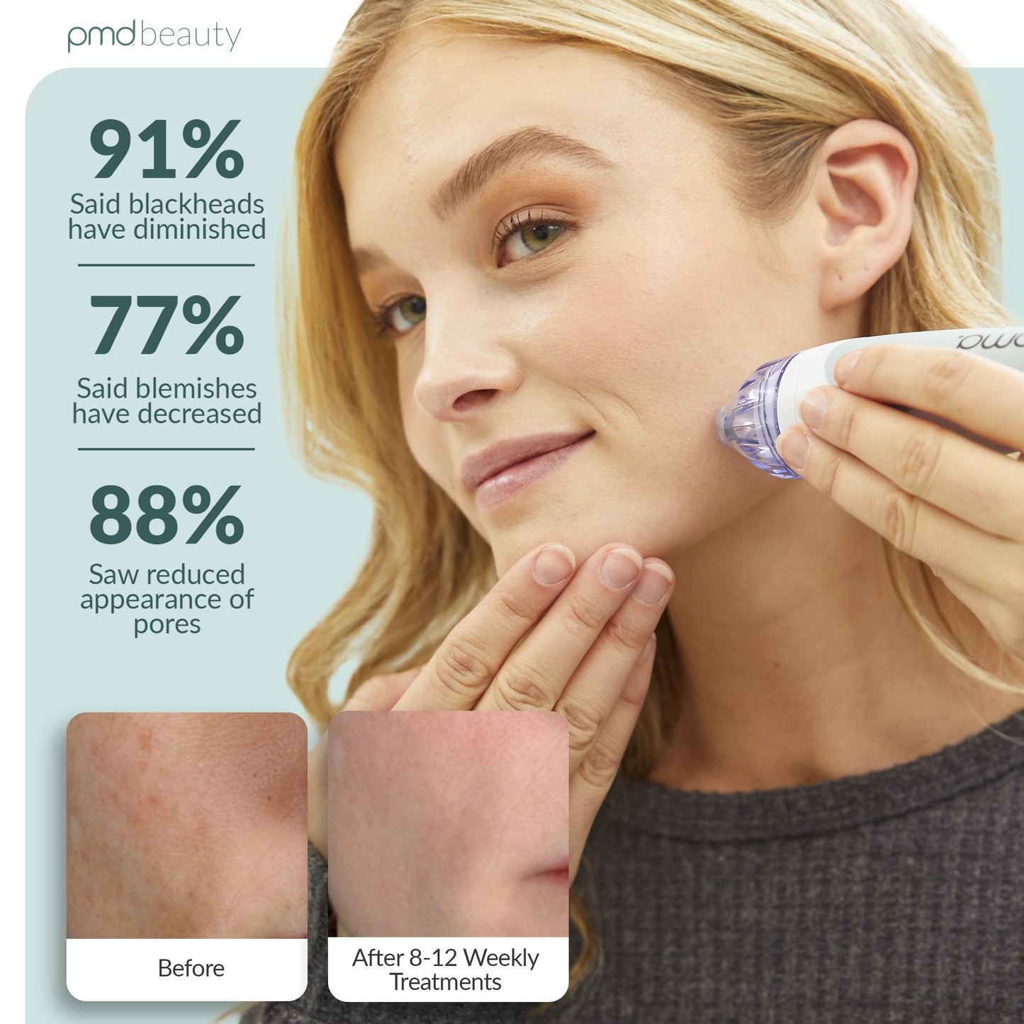 Personal Microderm Classic