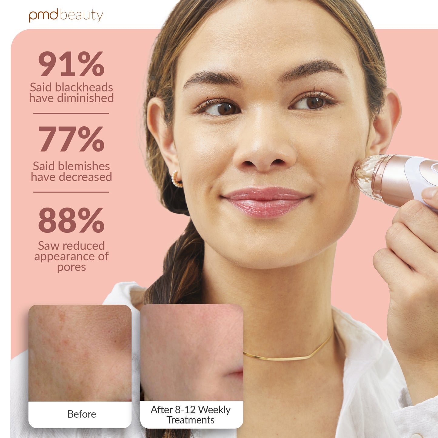 Personal Microderm Elite Pro