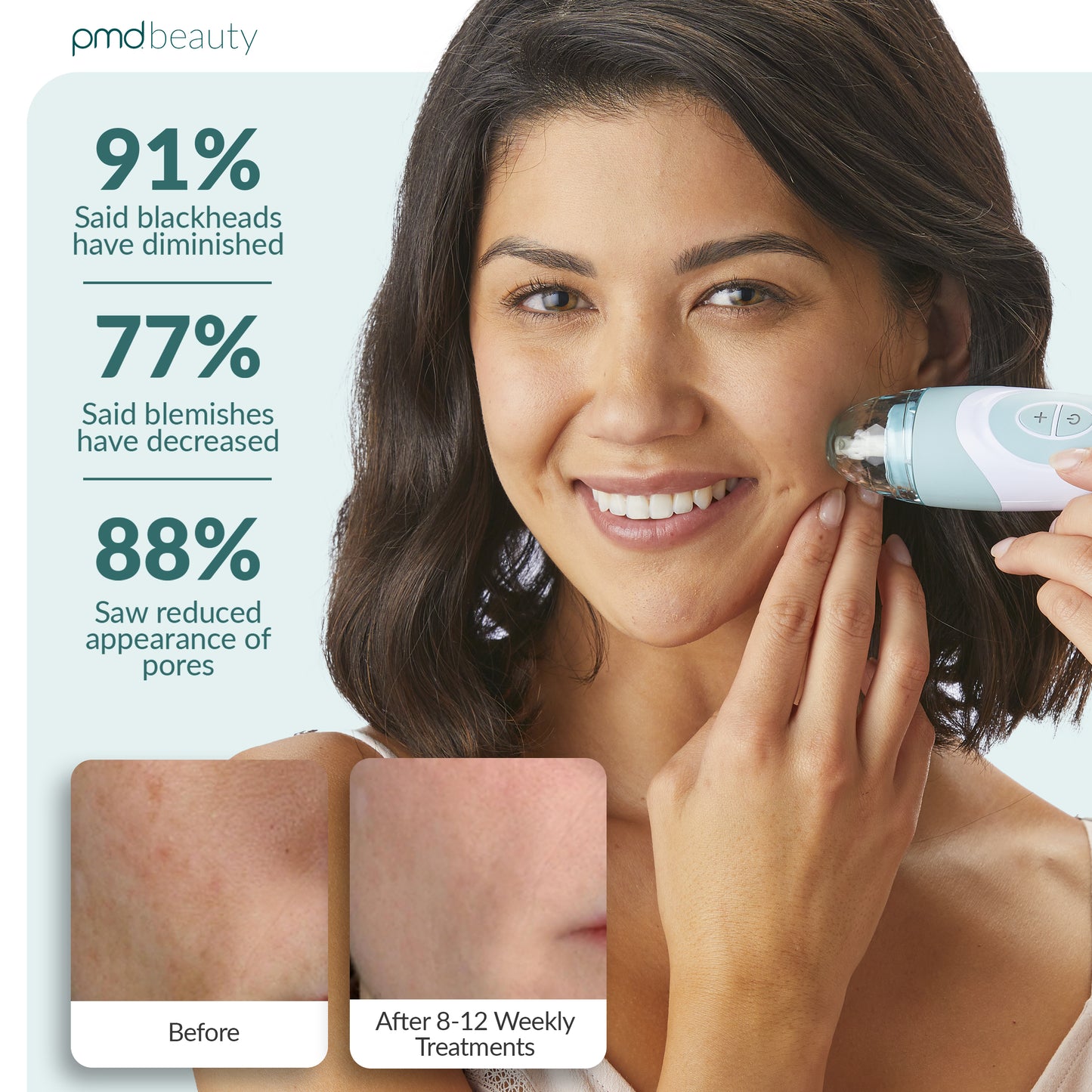 Personal Microderm Elite Pro