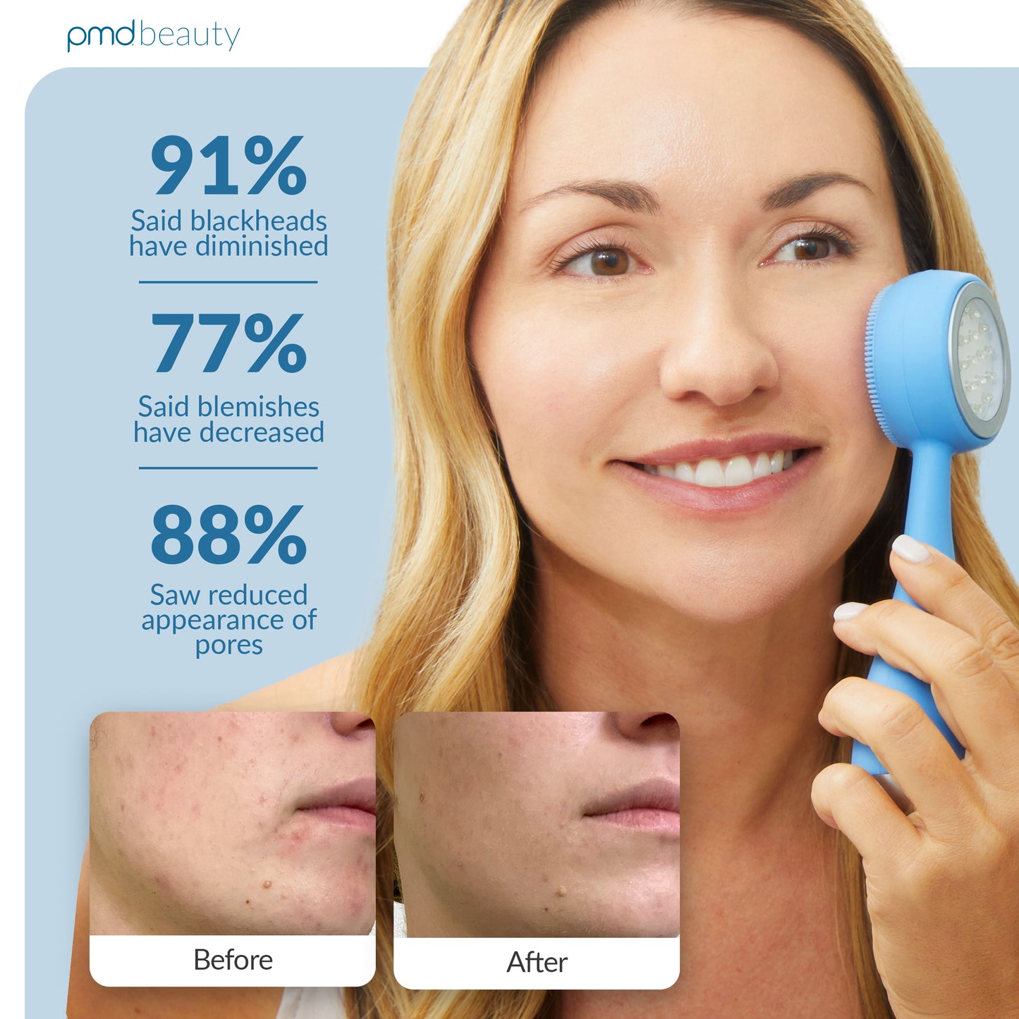 PMD Clean Acne