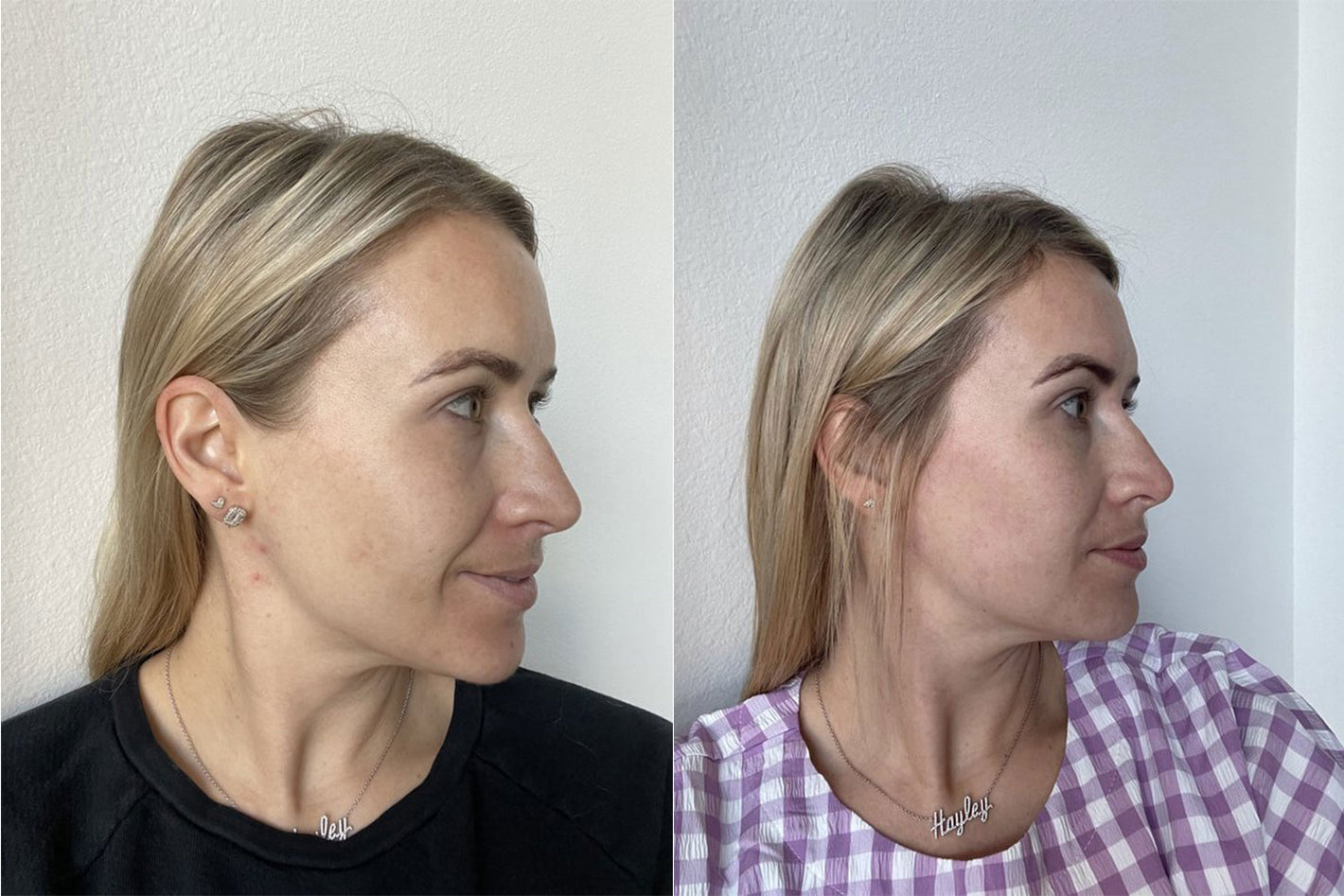 before and after results of using the PMD Clean