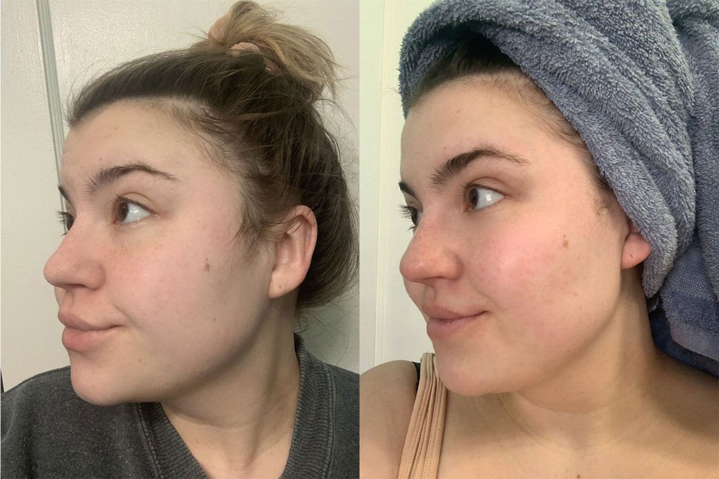 before and after results of using the PMD Clean