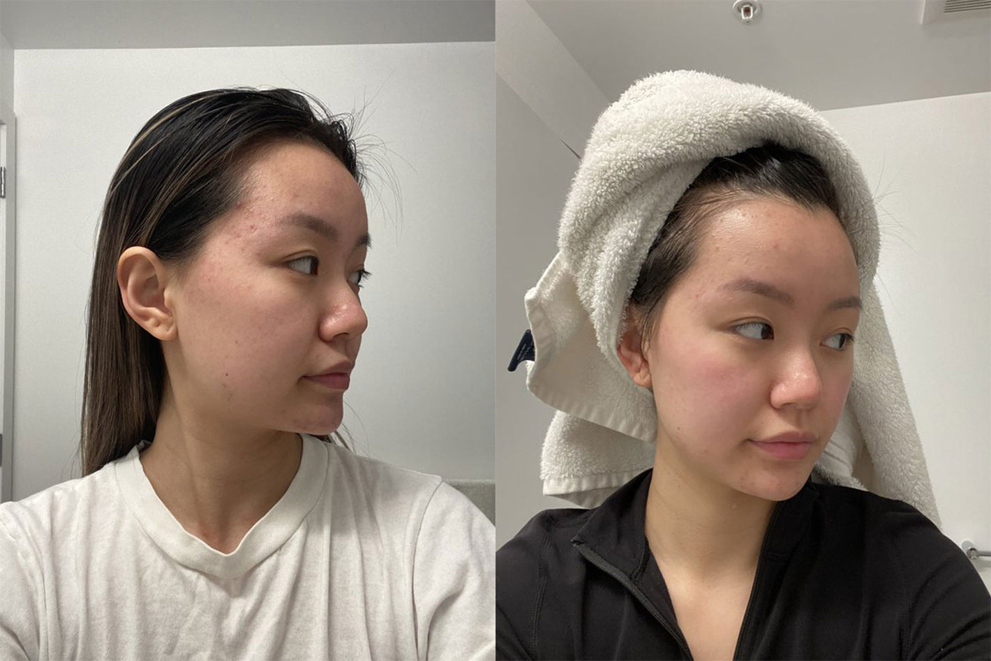 before & after using the Personal Microderm