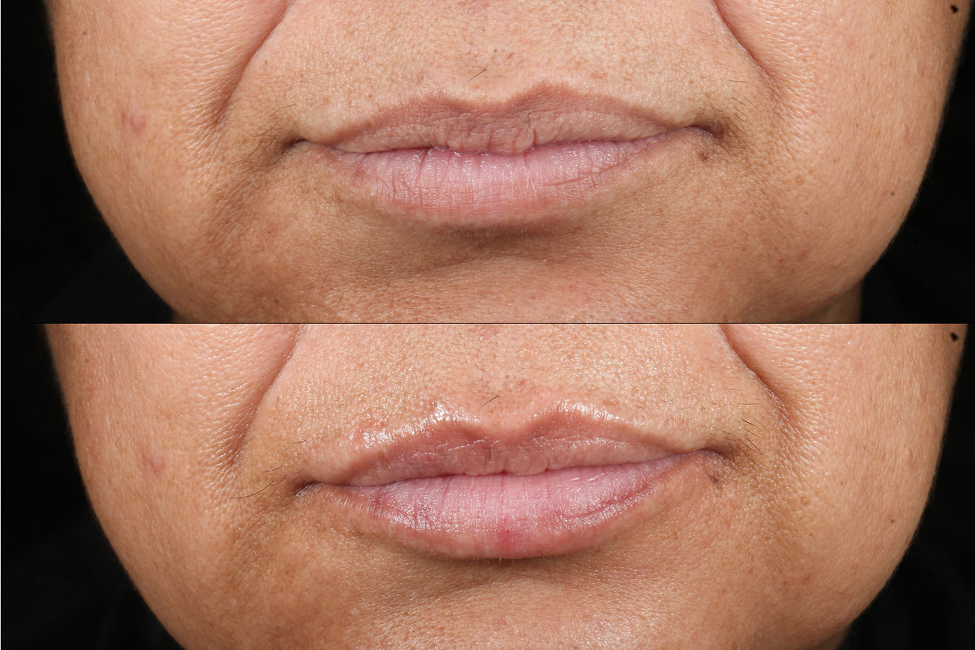 before and after using the PMD Kiss