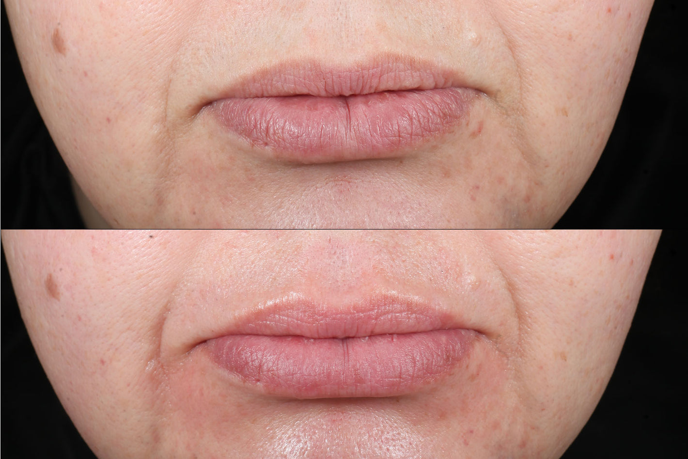 before and after using the PMD Kiss