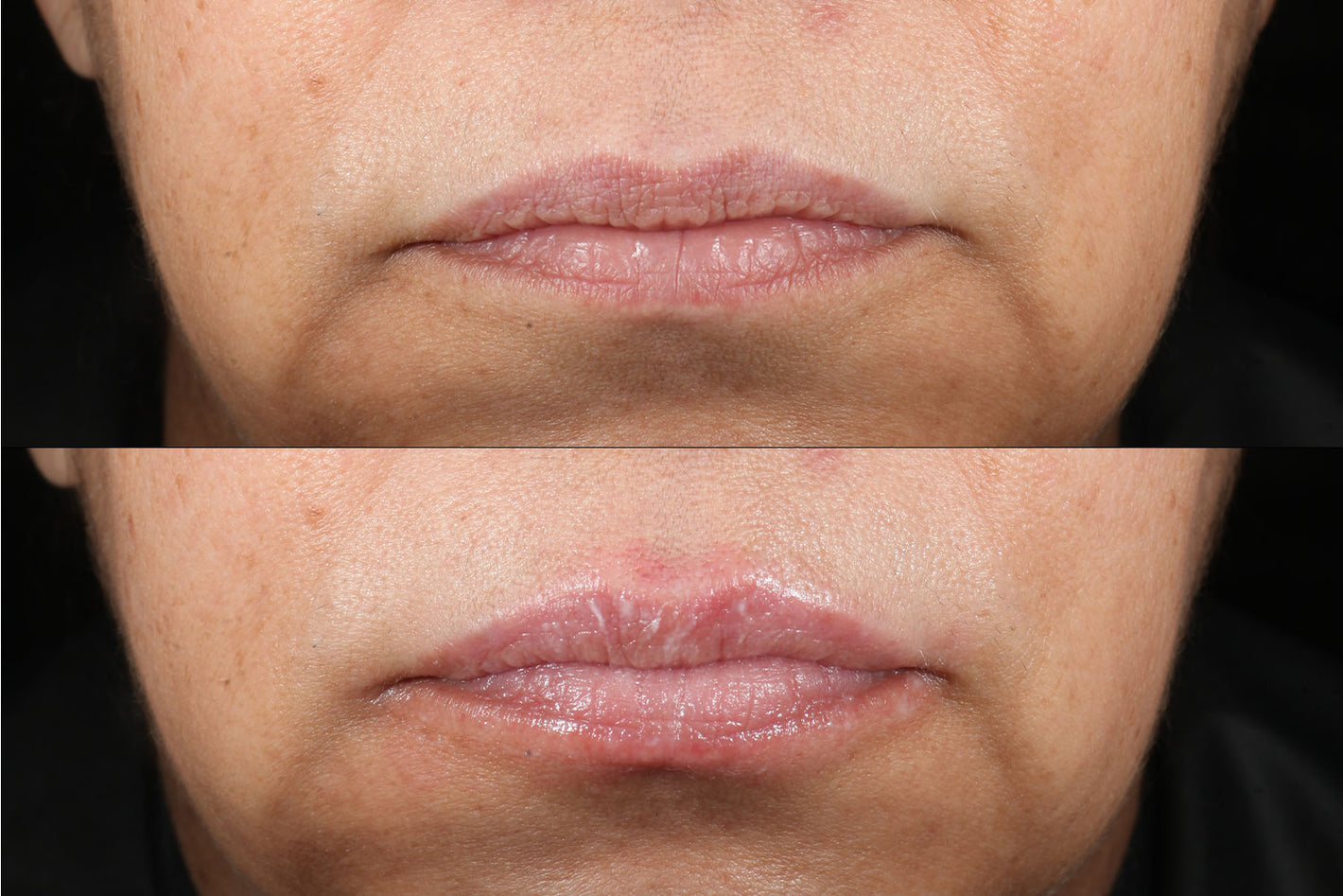 before and after using the PMD Kiss