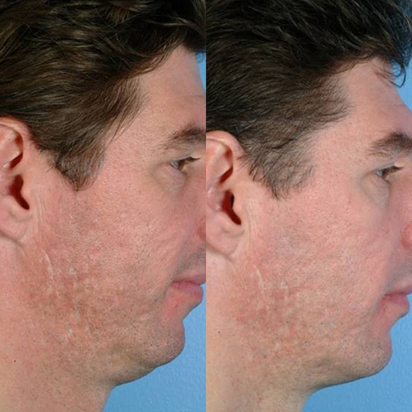 Personal Microderm Man