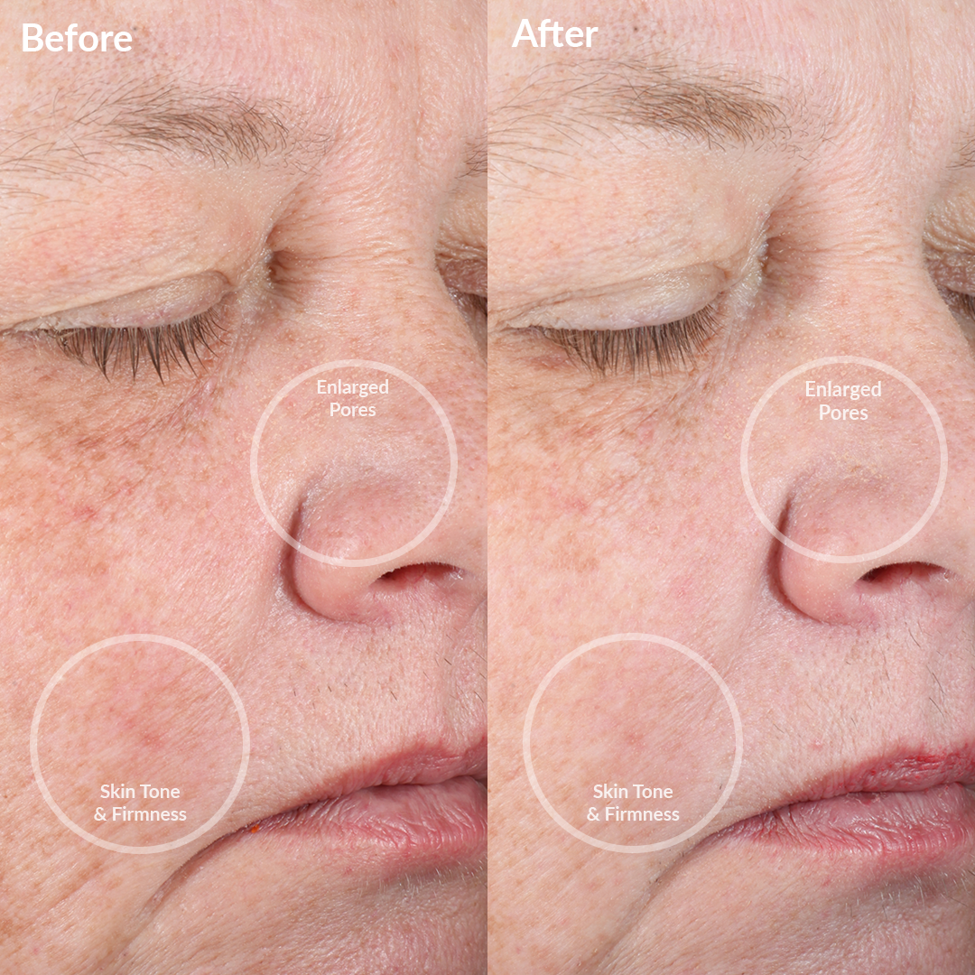 4002-CreamJ? Before and Afters of the PMD Clean Pro Jade