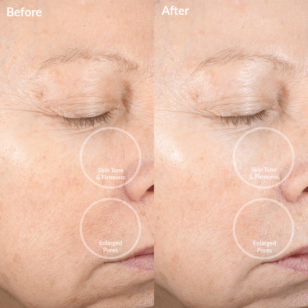 4002-SkyS? Before and After with the PMD Clean Pro Silver