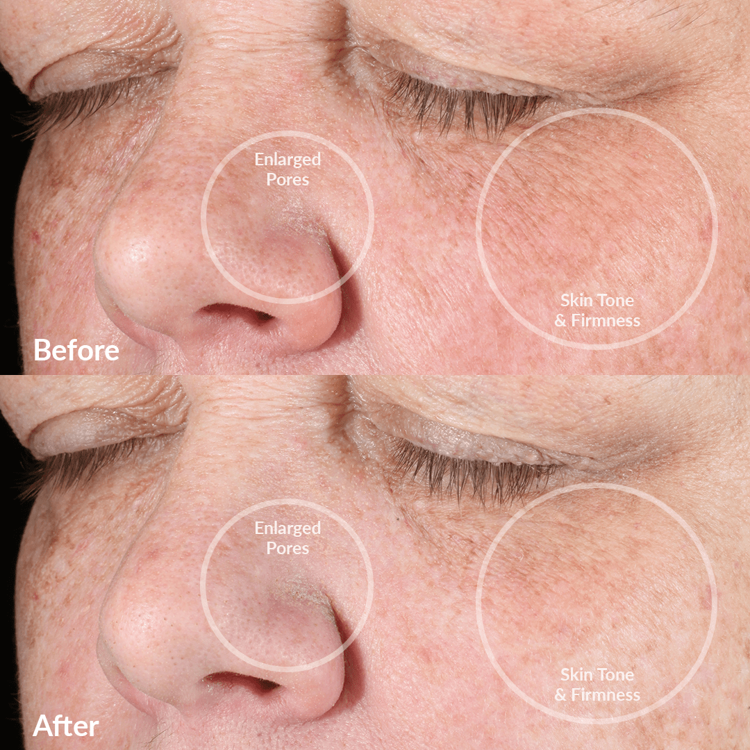 4002-RoseG? Before and Afters With the PMD Clean Pro Gold