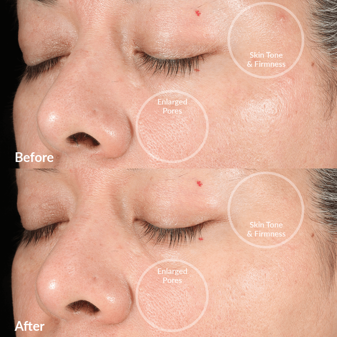 4002-BlackOB? Before and After From The PMD Clean Pro OB