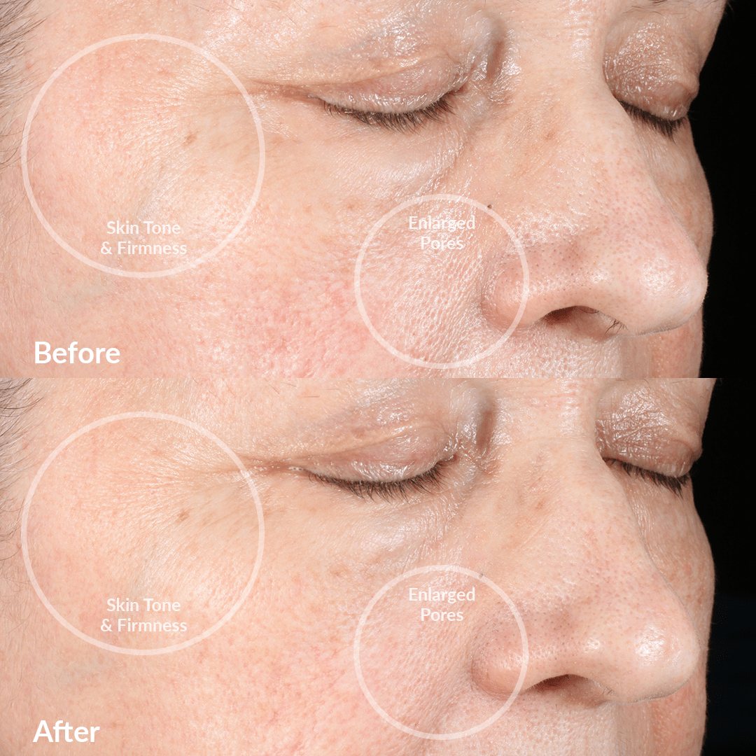 4002-BlushRQ? Before and After Results From The PMD Clean Pro RQ