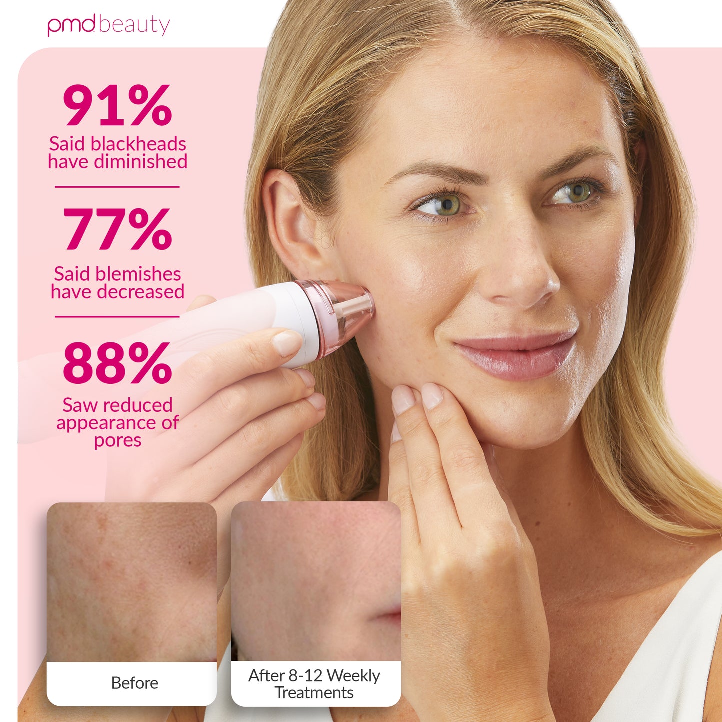 Personal Microderm Pro