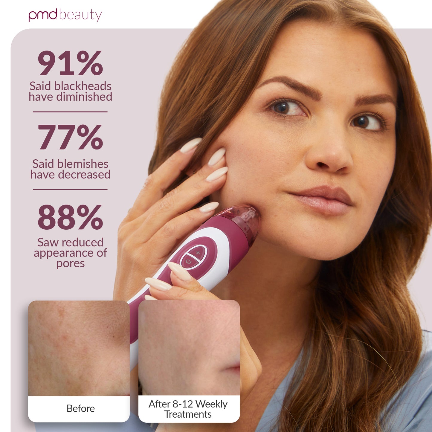 Personal Microderm Elite Pro