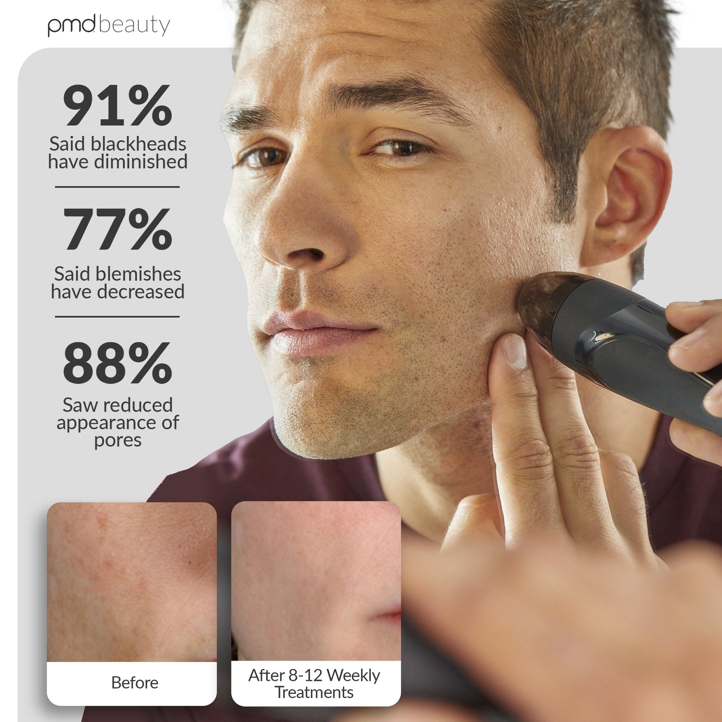 Personal Microderm Elite Pro