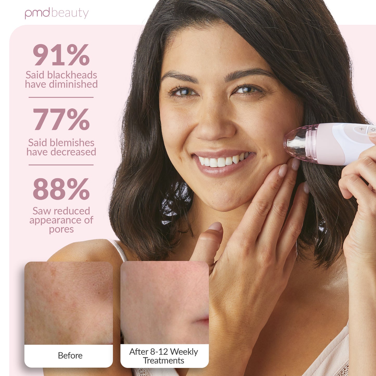 Personal Microderm Elite Pro