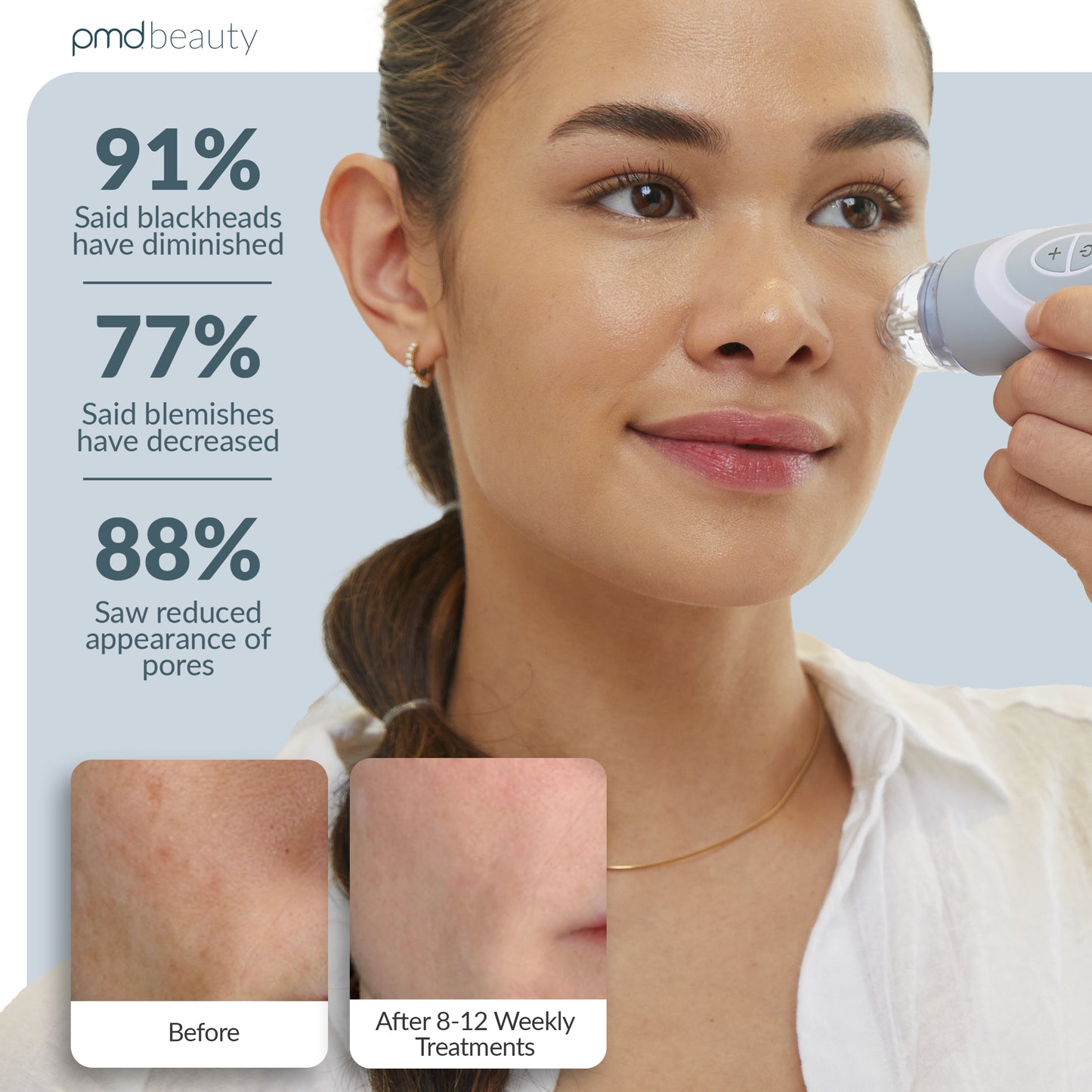 Personal Microderm Elite Pro