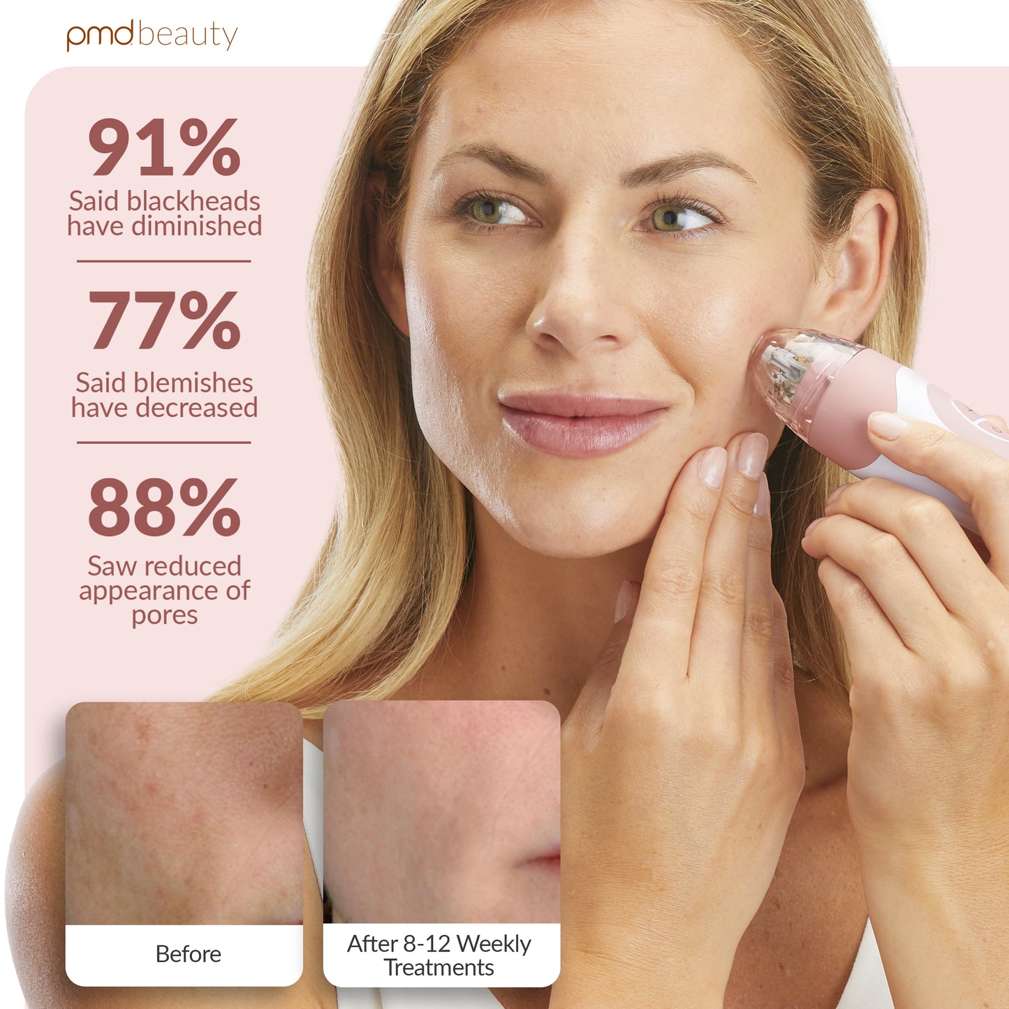 Personal Microderm Elite Pro