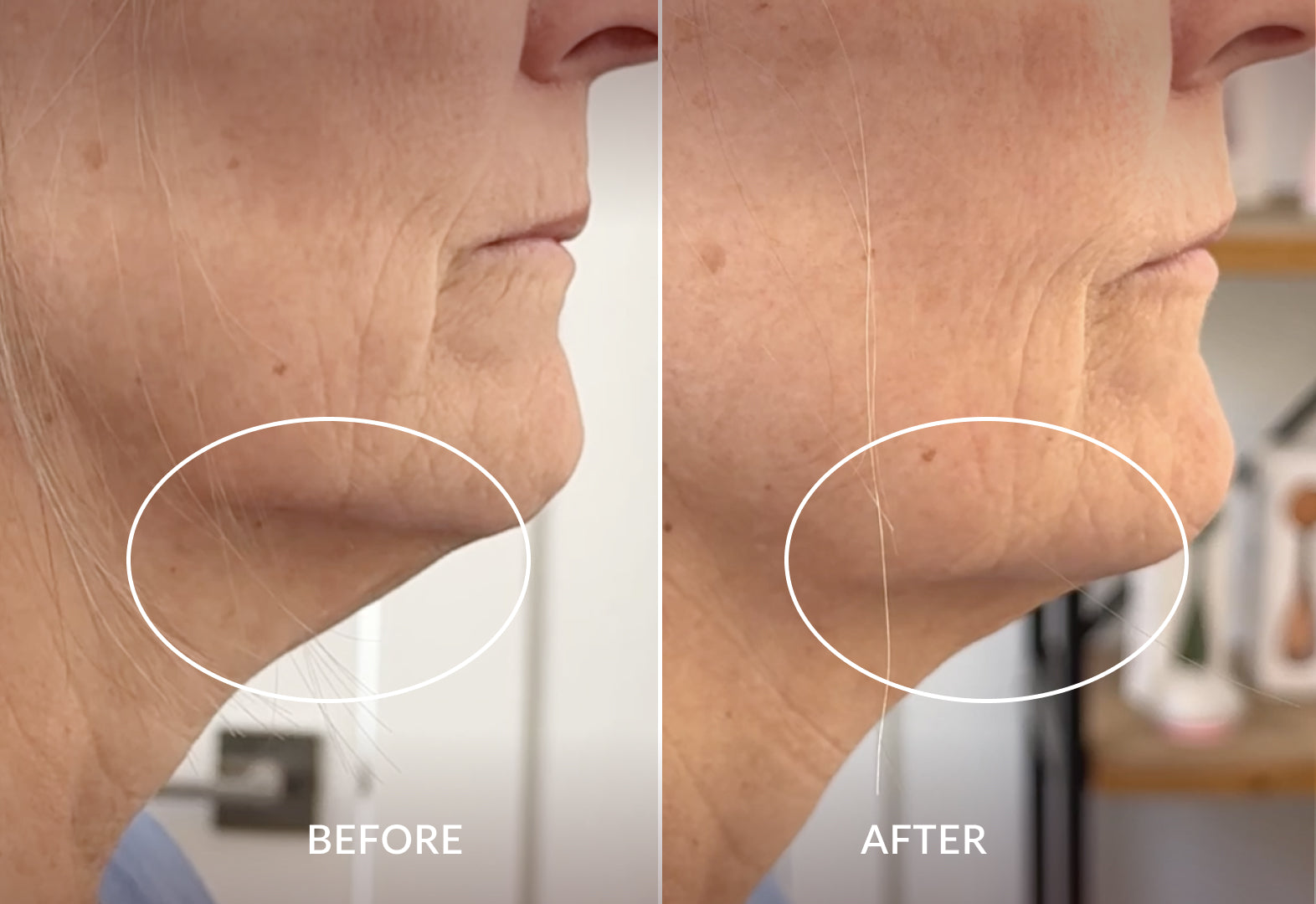 PMD SMAS Lifting Massage Band – PMD Beauty