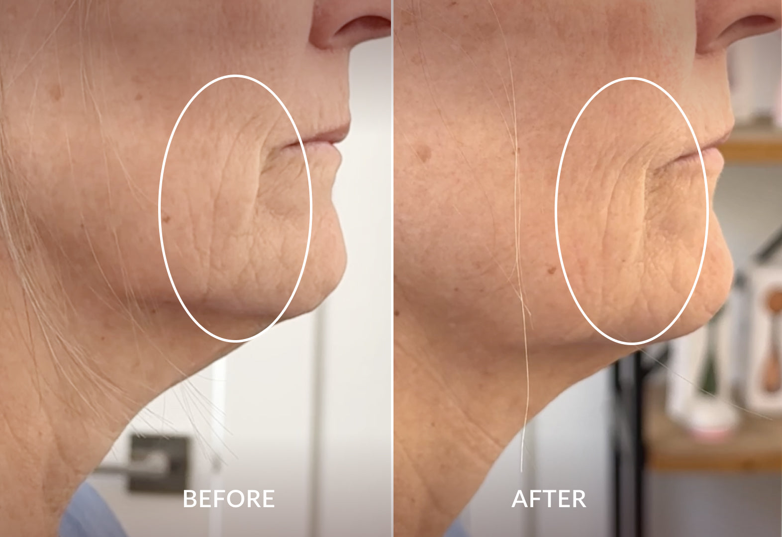 ボディ・フェイスケア pmD SMAS Full Face Beauty Band PMD SMAS Lifting Massage Band – PMD Beauty