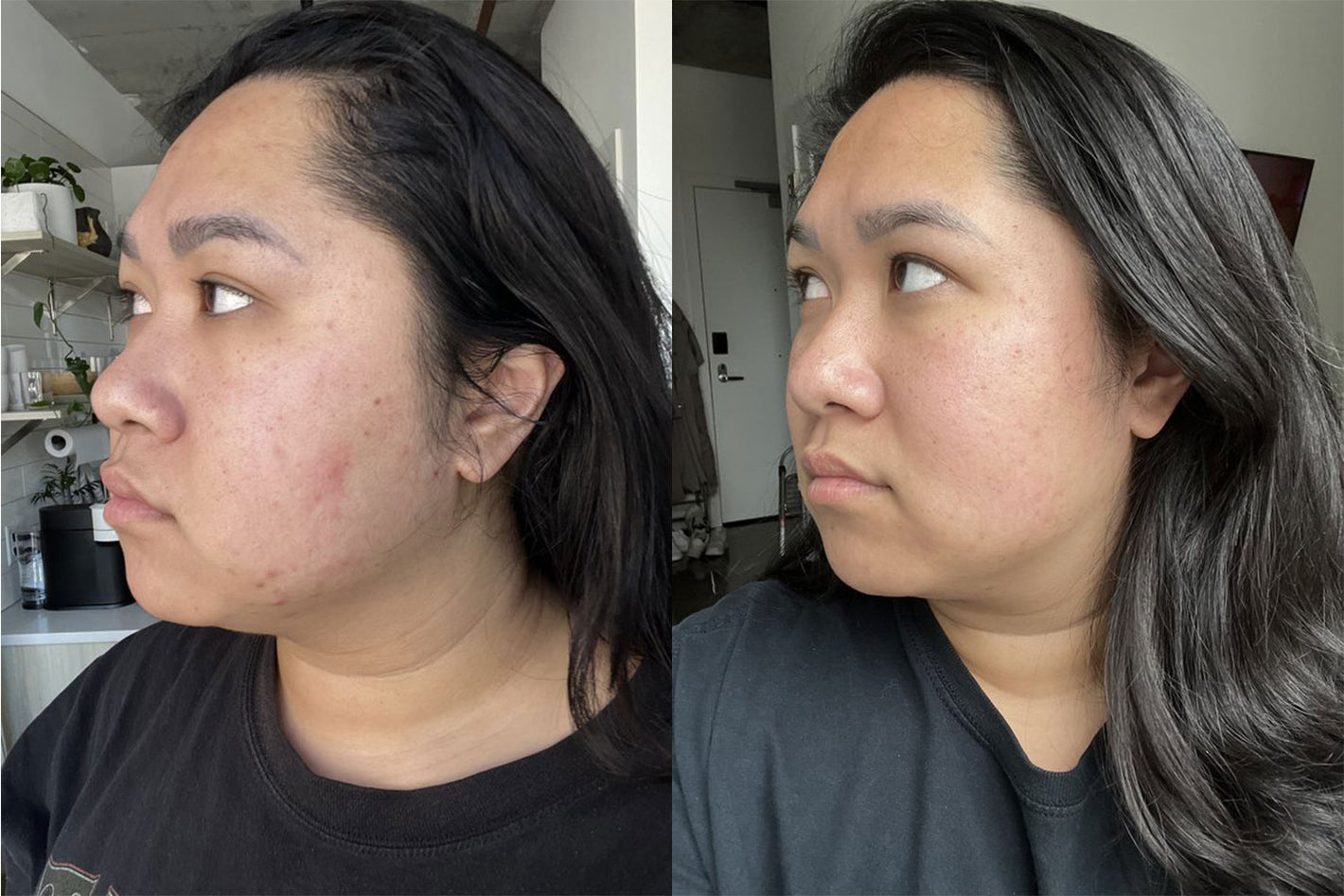 before and after results of using the PMD Clean
