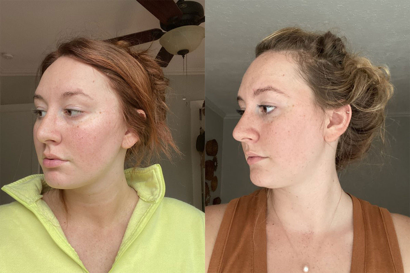 before & after using the Personal Microderm
