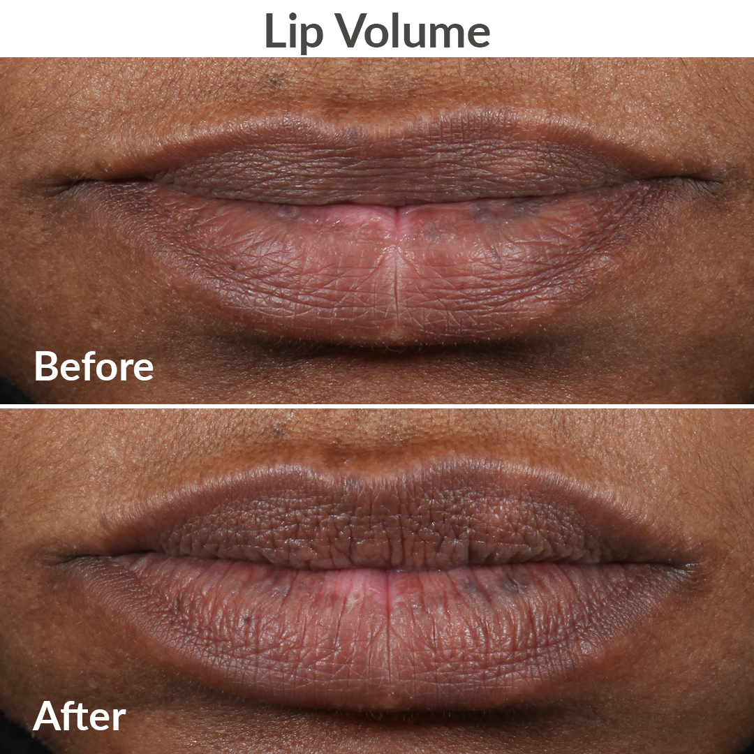 3001-KISS?Clinical trial lip volume Before & After using the PMD Kiss