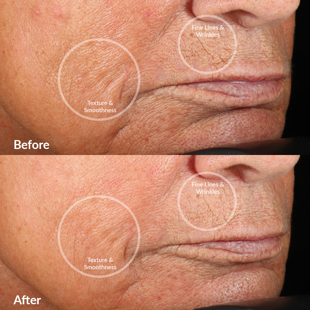 1002?Clinical trial Before & After using the Personal Microderm