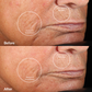 1001-berry?Clinical trial Before & After using the Personal Microderm