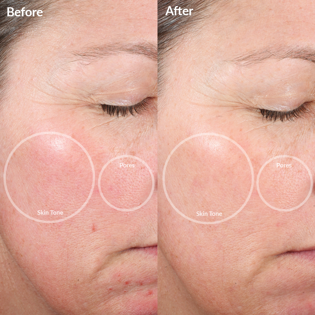 1005-MAUVE-MIN? Clinical trial Before & After image