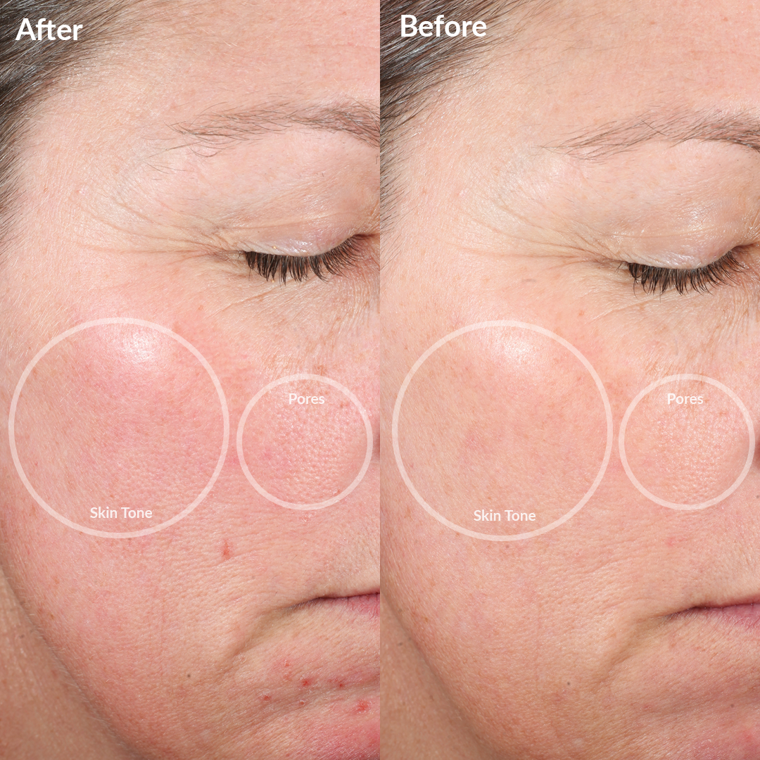 1005-LFGrey?Before and After of The Personal Microderm Elite Pro