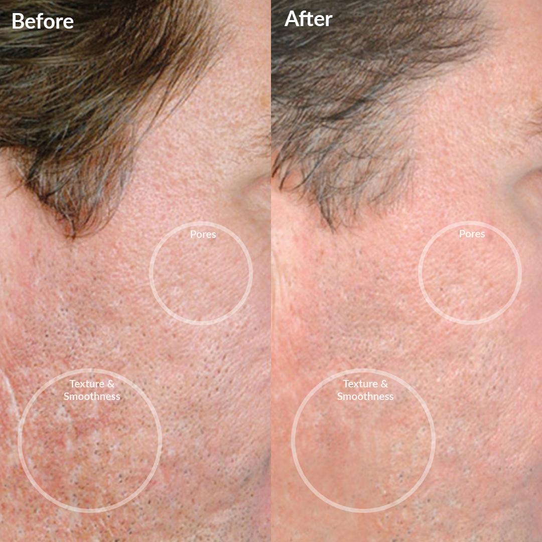 1001-BLACKPRO? Before and After of the Personal Microderm Pro Black