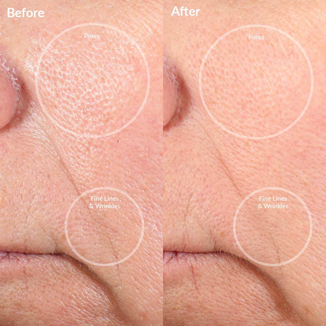 1001-LPURPRO? Before and After From The Personal Microderm Pro 