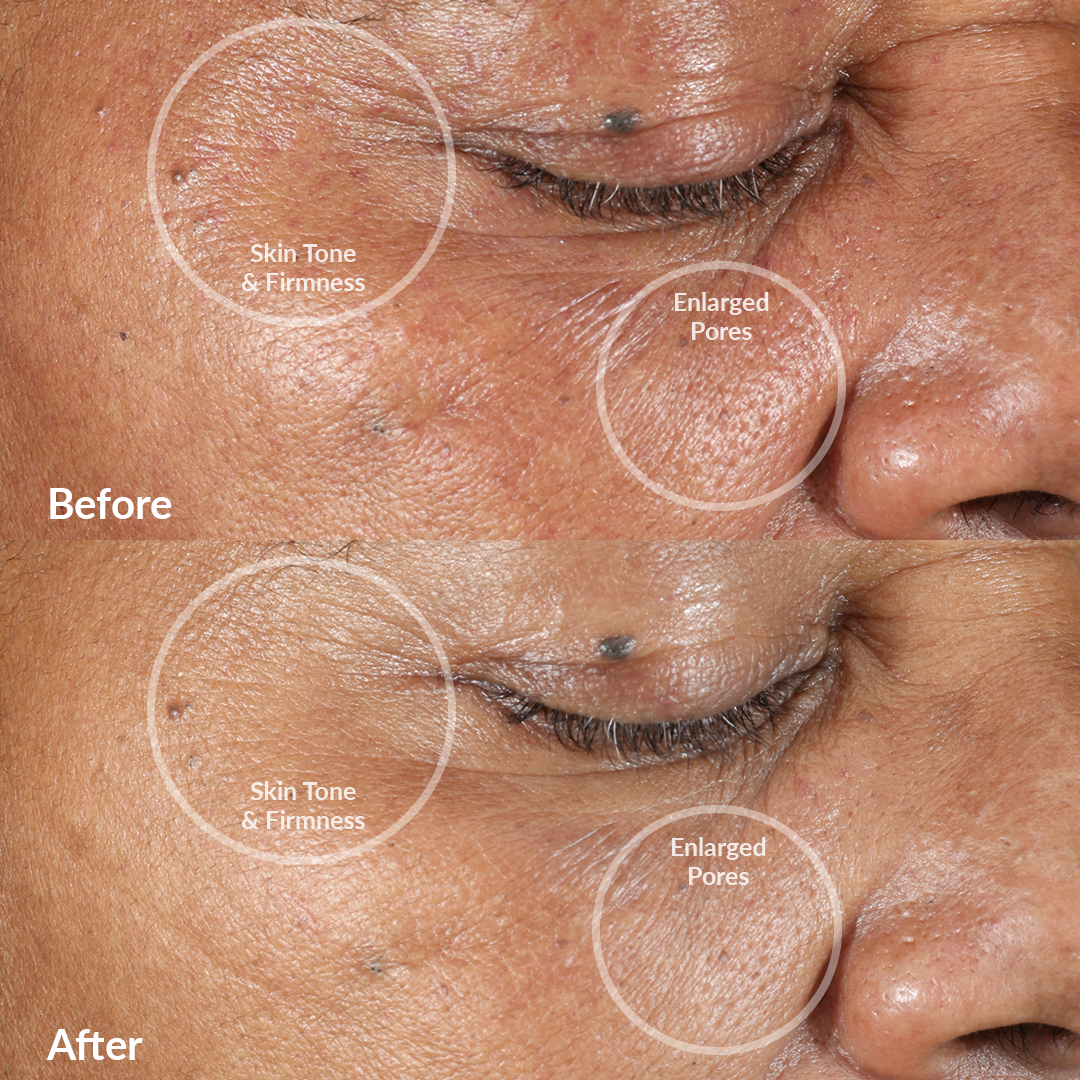 4001-CABLUE?Clinical trial Before & After using the PMD Clean