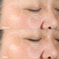 4001-Blush?Clinical trial Before & After using the PMD Clean