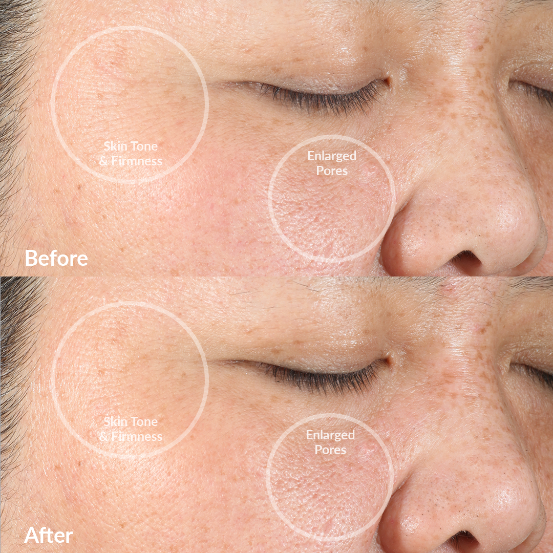 4001-NAVY?Clinical trial Before & After using the PMD Clean